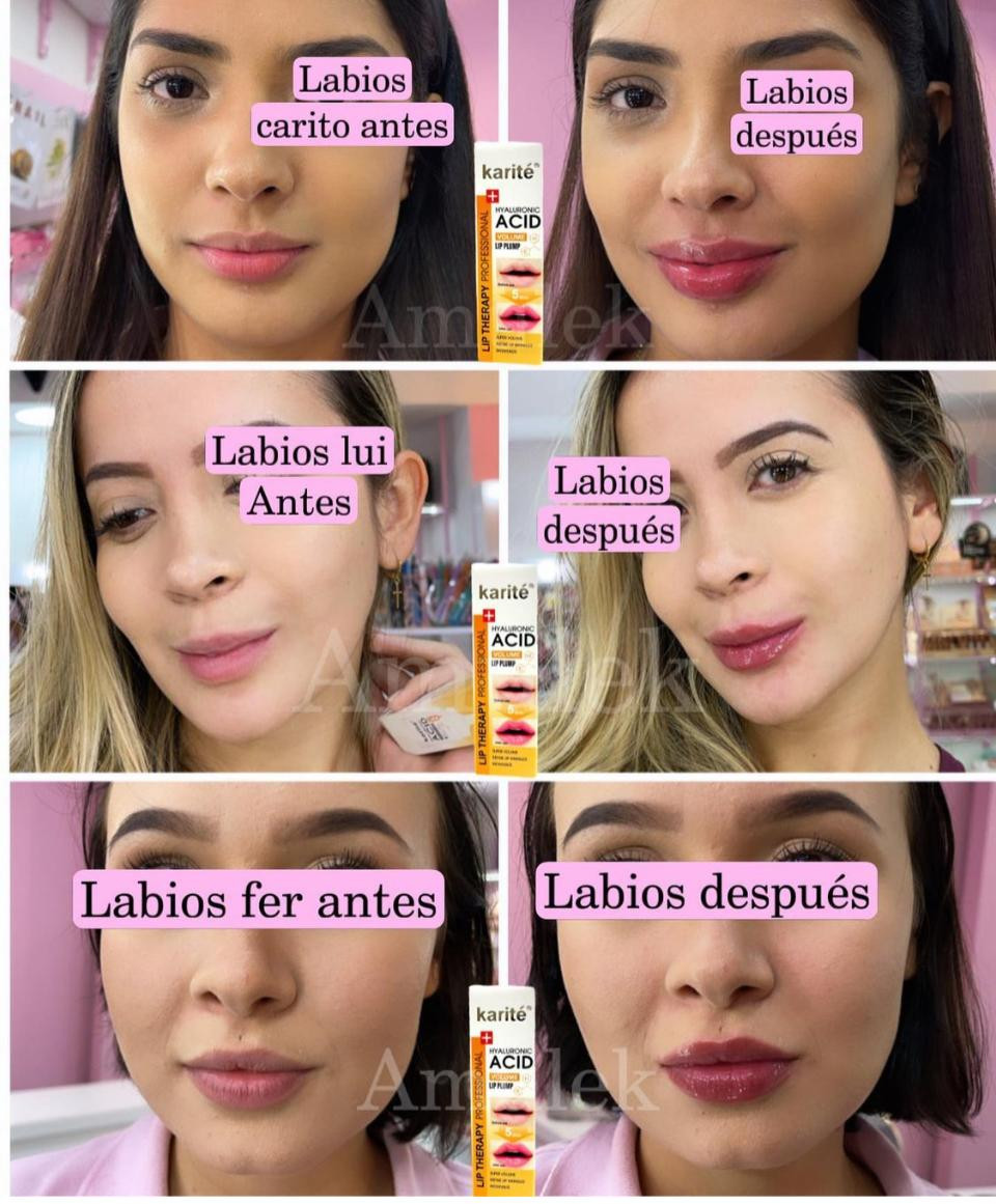Voluminizador de labios