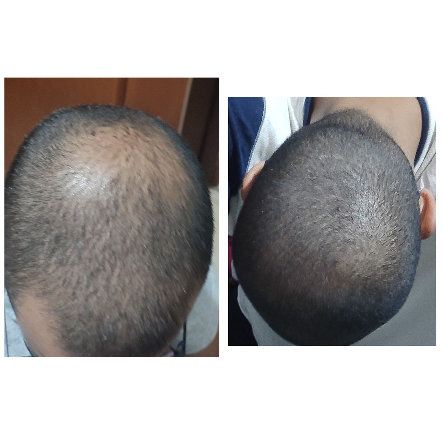 Minoxigrow Crecimiento de Cabello - Imagen 2